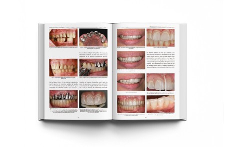 Las Claves de la Prótesis Fija en Cerámica