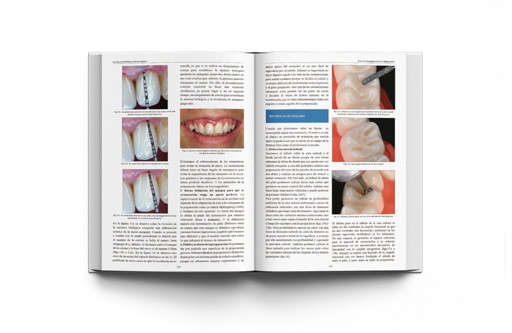 Las Claves de la Prótesis Fija en Cerámica