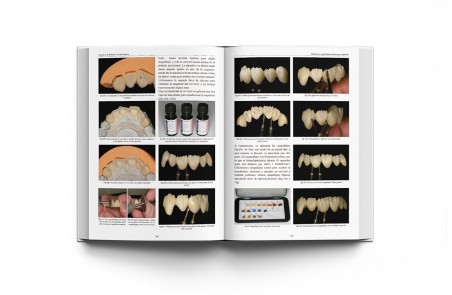Las Claves de la Prótesis Fija en Cerámica