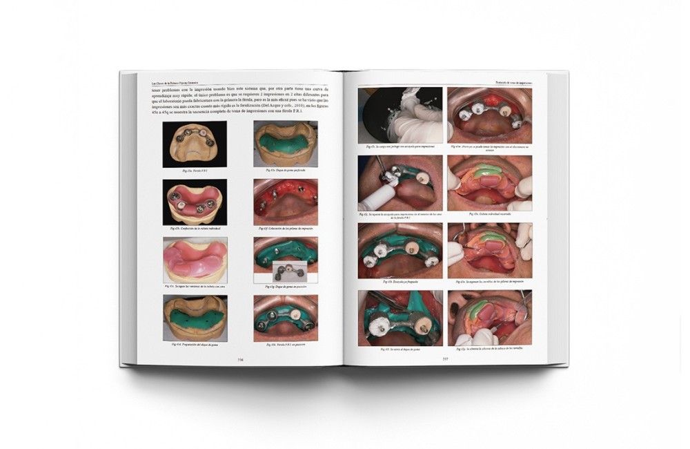 Las Claves de la Prótesis Fija en Cerámica