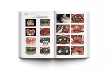 Las Claves de la Prótesis Fija en Cerámica