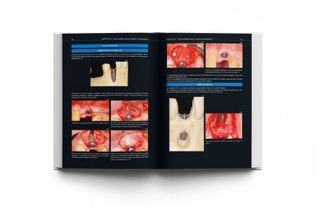 Atlas Clínico · Periimplantitis