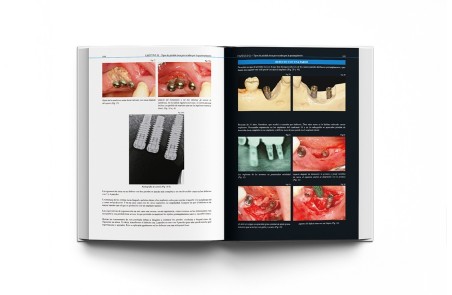 Atlas Clínico · Periimplantitis