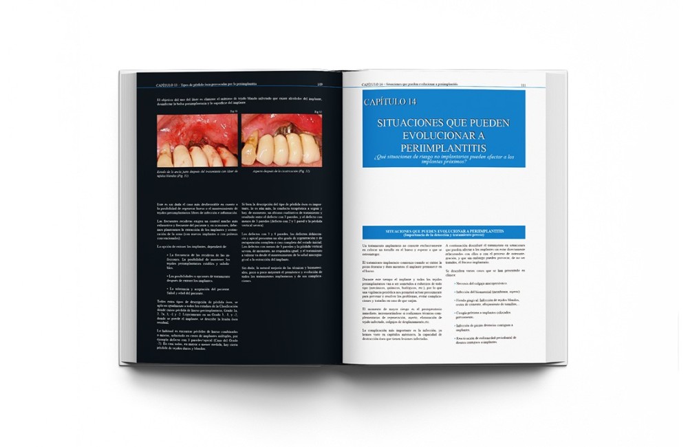 Atlas Clínico · Periimplantitis