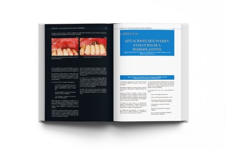 Atlas Clínico · Periimplantitis