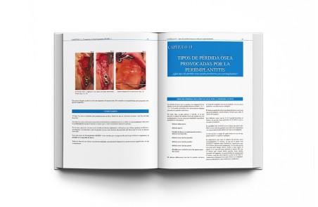 Atlas Clínico · Periimplantitis