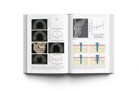 Técnicas clínicas de dispositivos de anclaje temporal en ortodoncia