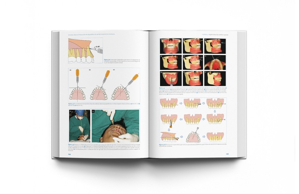 Técnicas clínicas de dispositivos de anclaje...