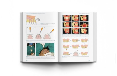 Técnicas clínicas de dispositivos de anclaje temporal en ortodoncia