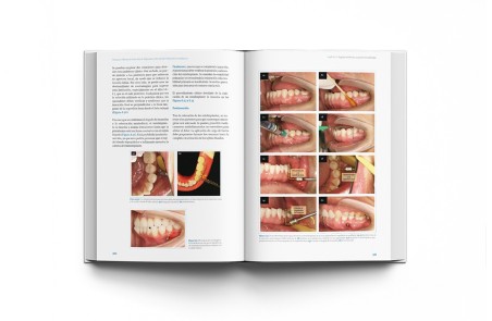 Técnicas clínicas de dispositivos de anclaje temporal en ortodoncia
