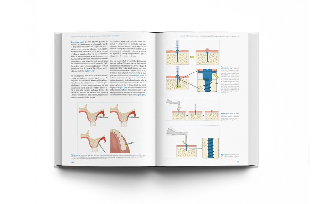 Técnicas clínicas de dispositivos de anclaje...