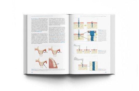 Técnicas clínicas de dispositivos de anclaje temporal en ortodoncia