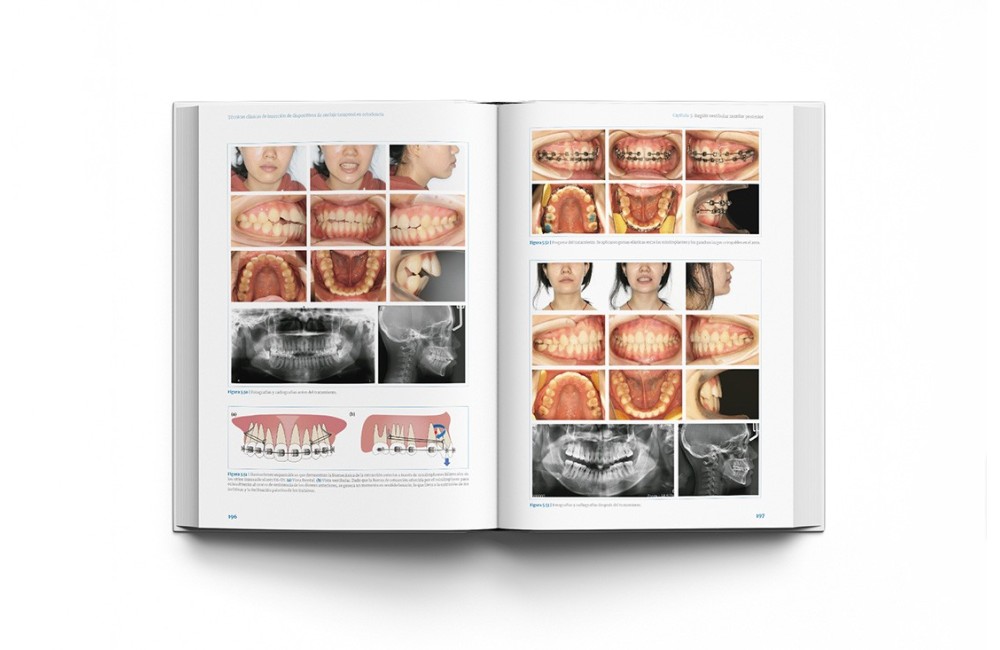 Técnicas clínicas de dispositivos de anclaje...