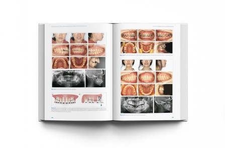 Técnicas clínicas de dispositivos de anclaje temporal en ortodoncia