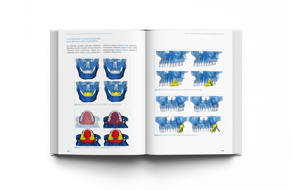 Técnicas clínicas de dispositivos de anclaje...