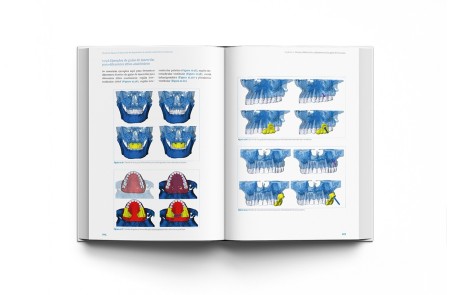 Técnicas clínicas de dispositivos de anclaje temporal en ortodoncia