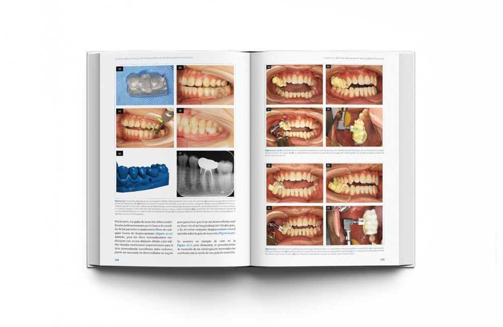 Técnicas clínicas de dispositivos de anclaje...