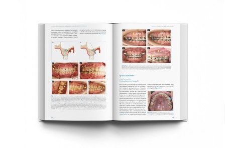 Técnicas clínicas de dispositivos de anclaje temporal en ortodoncia