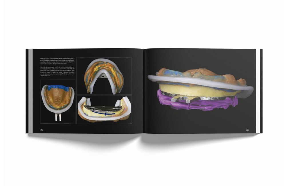 Sistema de Prótese Biofuncional (BPS)® Passo a...