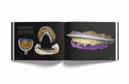 Sistema de Prótese Biofuncional (BPS)® Passo a Passo – Português