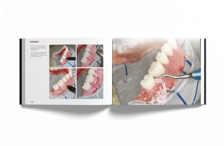 Sistema de Prótese Biofuncional (BPS)® Passo a Passo – Português