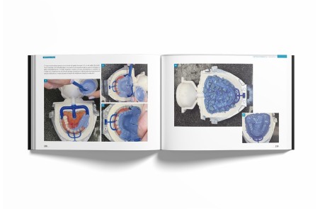 Sistema de Prótese Biofuncional (BPS)® Passo a Passo – Português