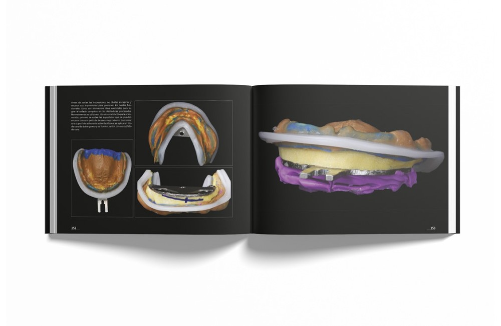 Sistema de Prótesis Biofuncional (BPS)® Paso a...