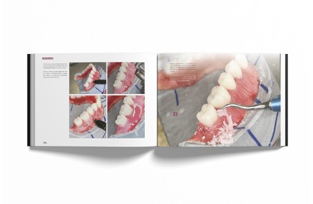 Sistema de Prótesis Biofuncional (BPS)® Paso a Paso