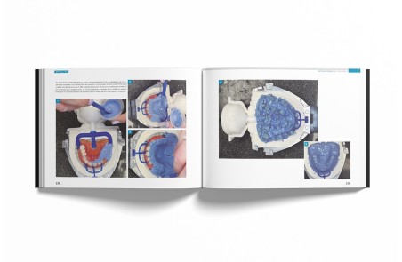 Sistema de Prótesis Biofuncional (BPS)® Paso a Paso