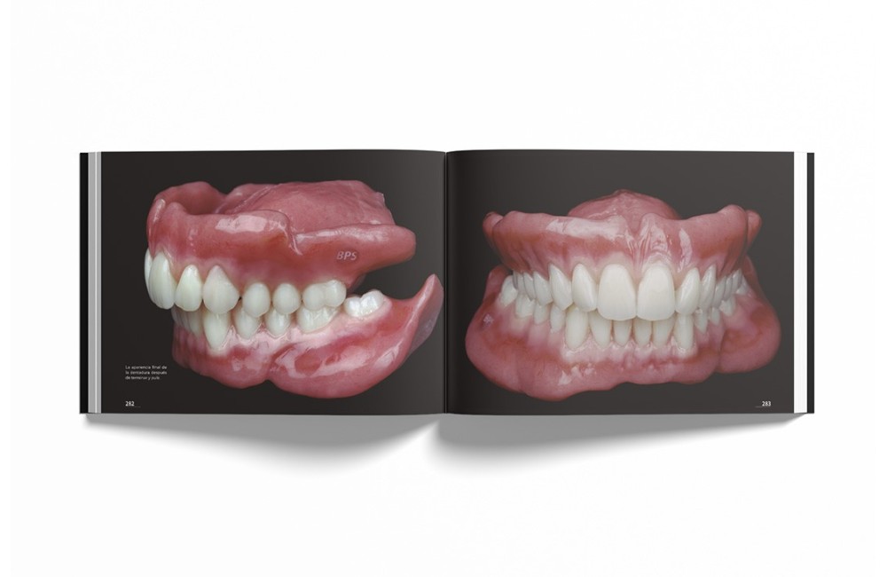 Sistema de Prótesis Biofuncional (BPS)® Paso a...