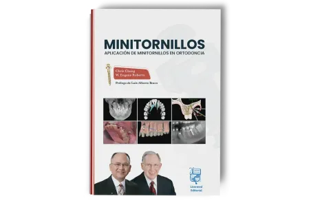 Minitornillos. Aplicaciones clínicas en ortodoncia