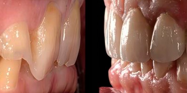 Oclusión y rehabilitación en los casos de grandes desgastes